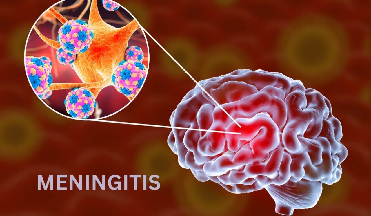 Meningitis Meningitis