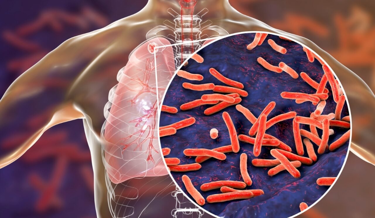 Tuberculosis-1280x744.jpg
