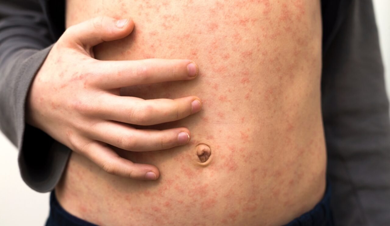 Measles Cases Surge in Texas and New Mexico, Outbreak Spreads Further Measles Cases Surge in Texas and New Mexico, Outbreak Spreads Further