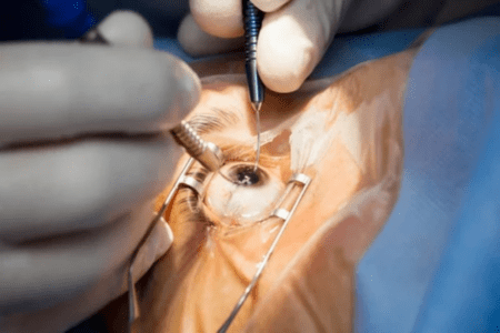 cataract-surgery-2.png