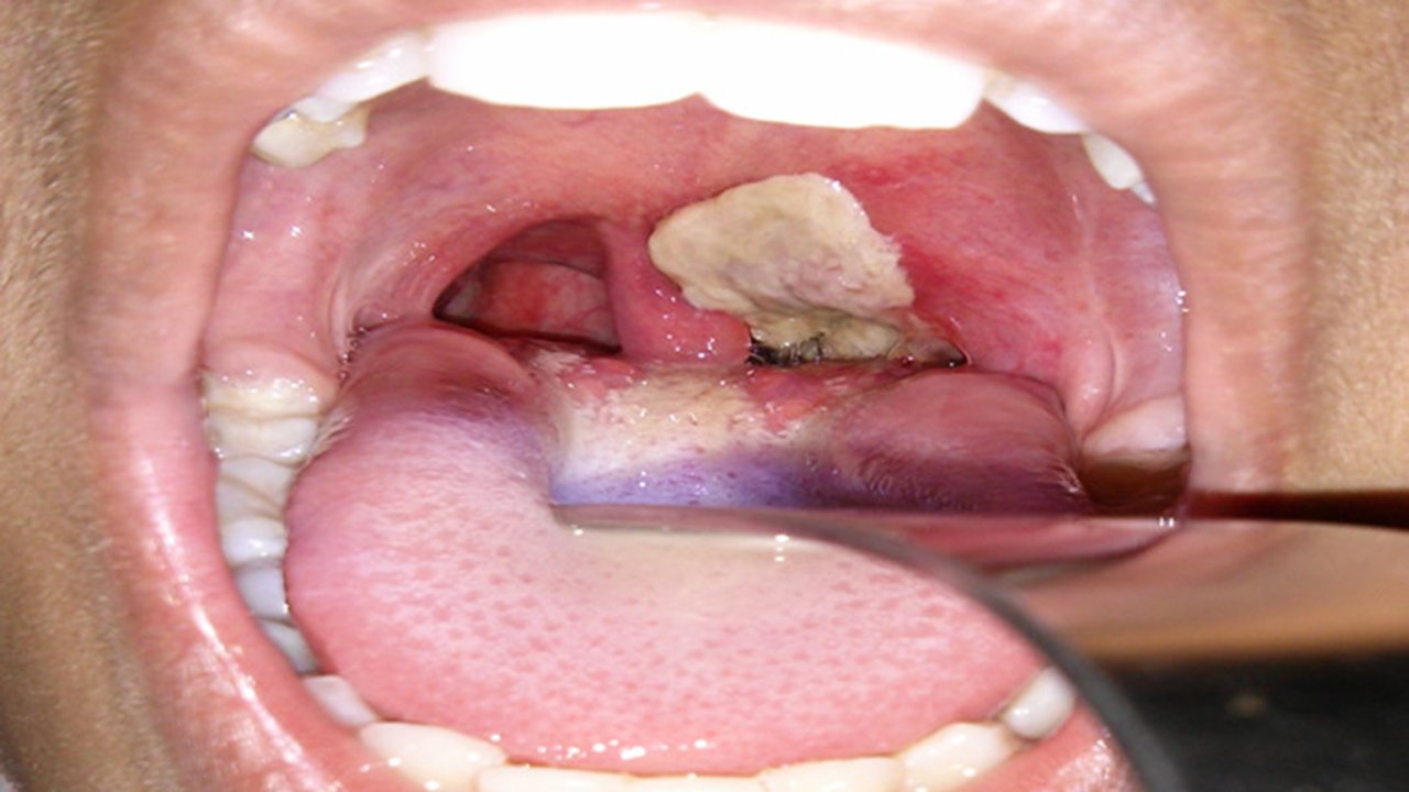 DIPHTHERIA DIPHTHERIA