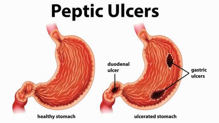 ulcer.jpg